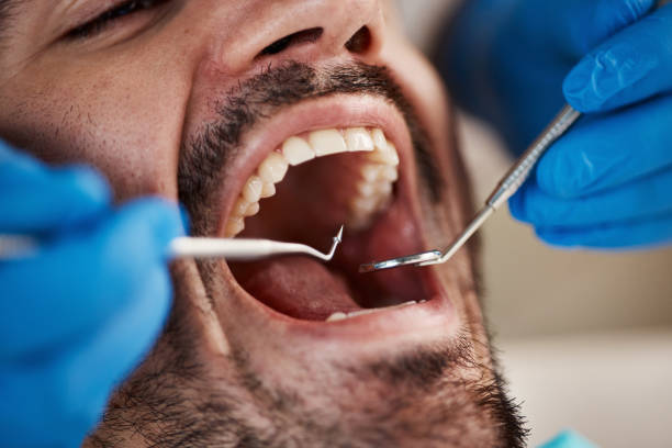 Best Emergency Wisdom Tooth Extraction in Galliano, LA